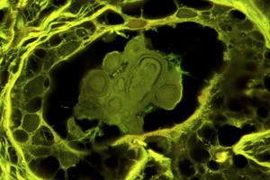 Benign breast disease nodules