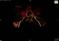Scaling up a Nanoimmunotherapy for Atherosclerosis Through Preclinical Testing (3 of 8)