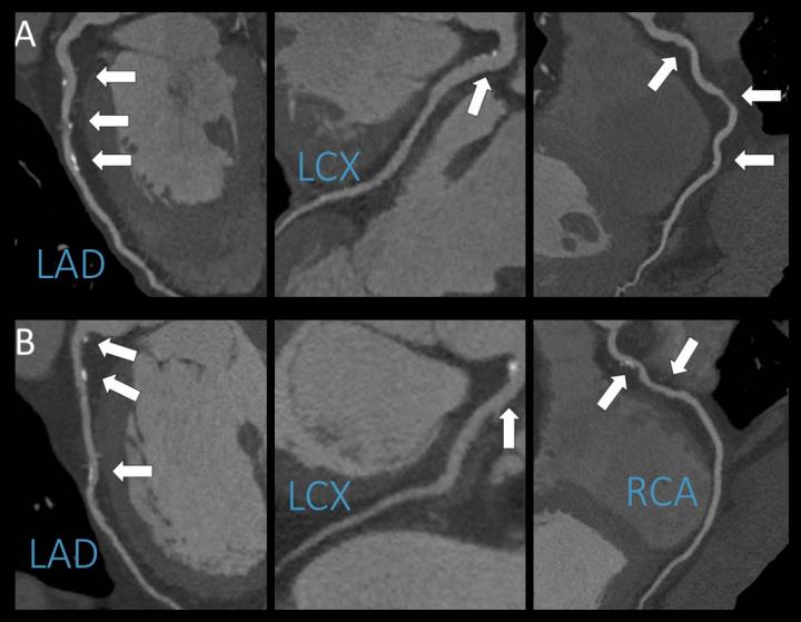 Example of Coronary CT