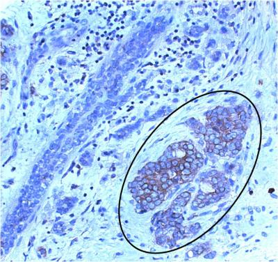 Potential Target for Breast Cancer Therapy