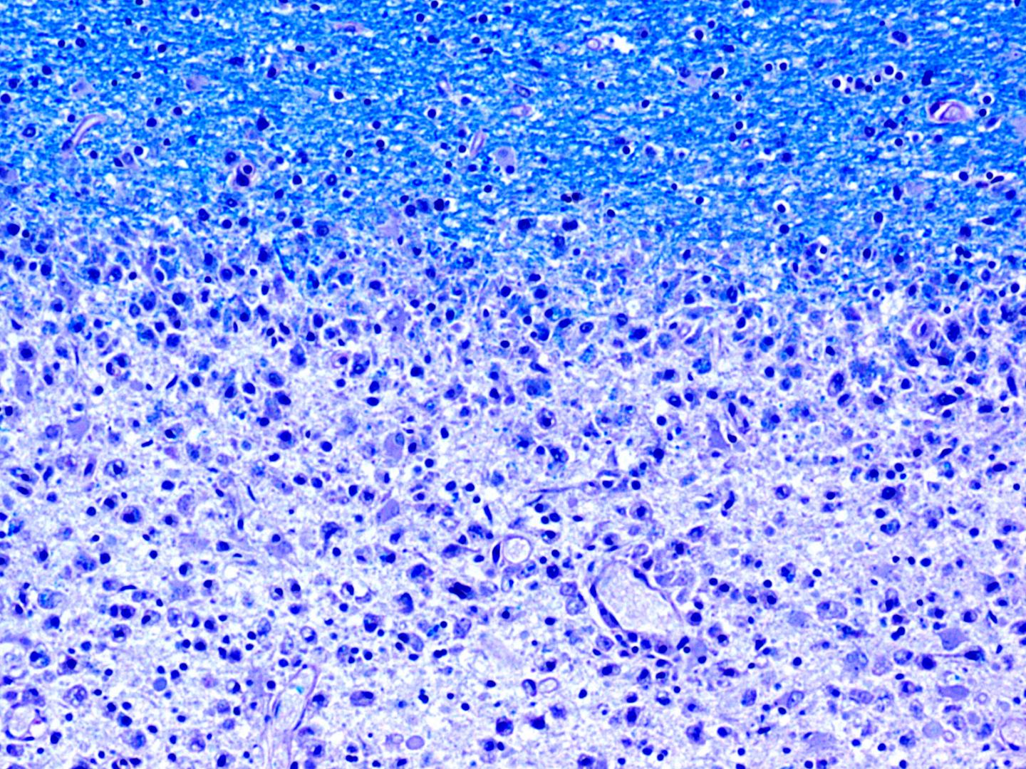 T Cells Target an Enzyme Associated With Gut Microbiota in Multiple Sclerosis (2 of 2)
