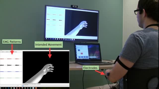 Phantom Movements in Augmented Reality Helps Patients with Chronic Intractable Phantom Limb Pain
