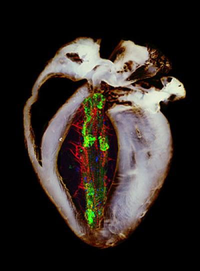 Missing Link in Parkinson's Disease Found (1 of 3)