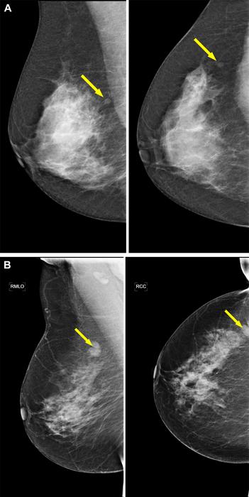 Example screening mammograms with an invasive ductal carcinoma