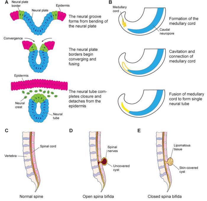 Neurulation and its relation to the development of spina bifida subtypes.