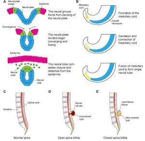 Neurulation and its relation to the development of spina bifida subtypes.