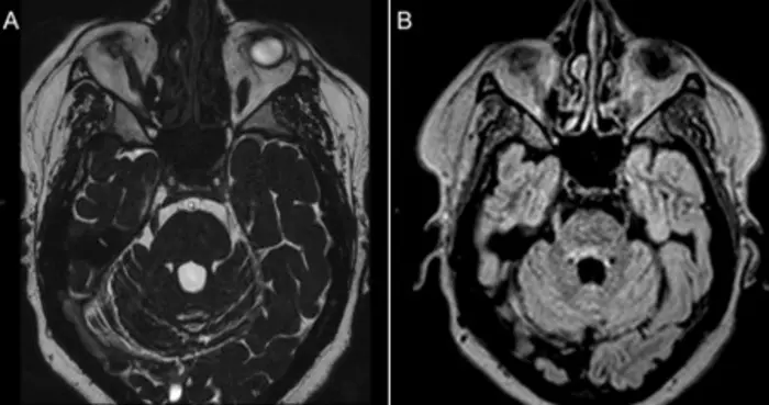 Brain MRI showing demyelinating lesion near the trigeminal nerve and absence of neurovascular compression