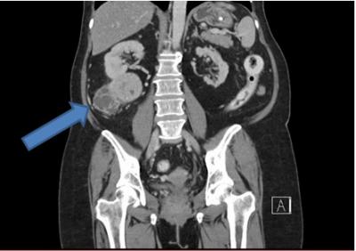 Kidney Tumor CT Scan