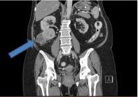 Kidney Tumor CT Scan