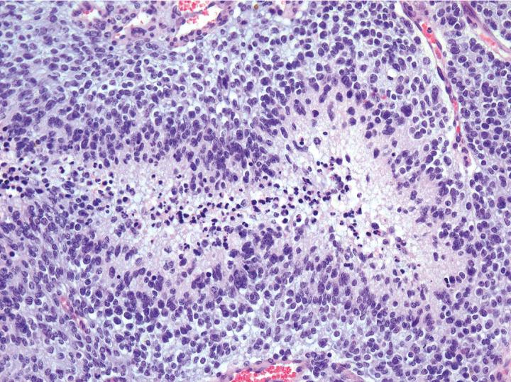 Glioblastoma