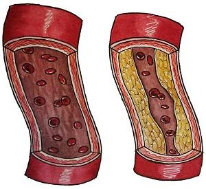 A Healthy Artery (Left) and An Atery Affected by Atherosclerosis (Right)