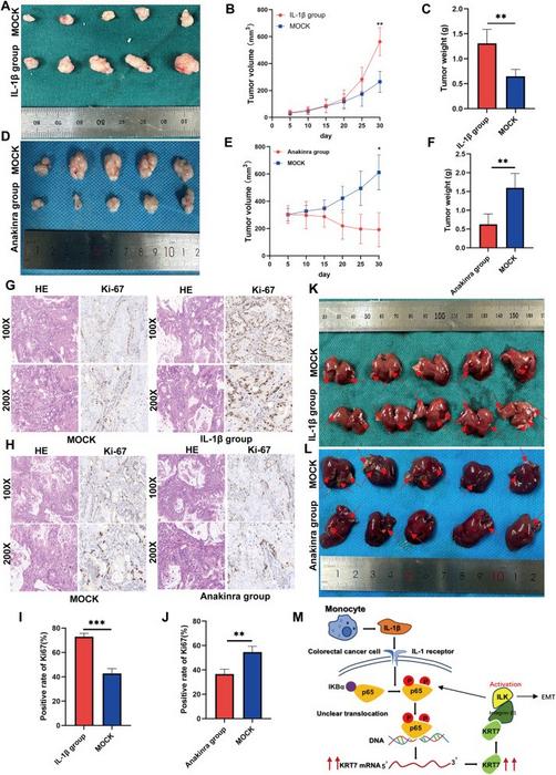 IL1β promotes the proliferation, migration, and invasion of colorectal cancer cells in vivo.