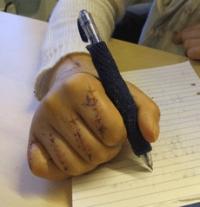 Hand Surgery Enhances Life Quality (2 of 2)