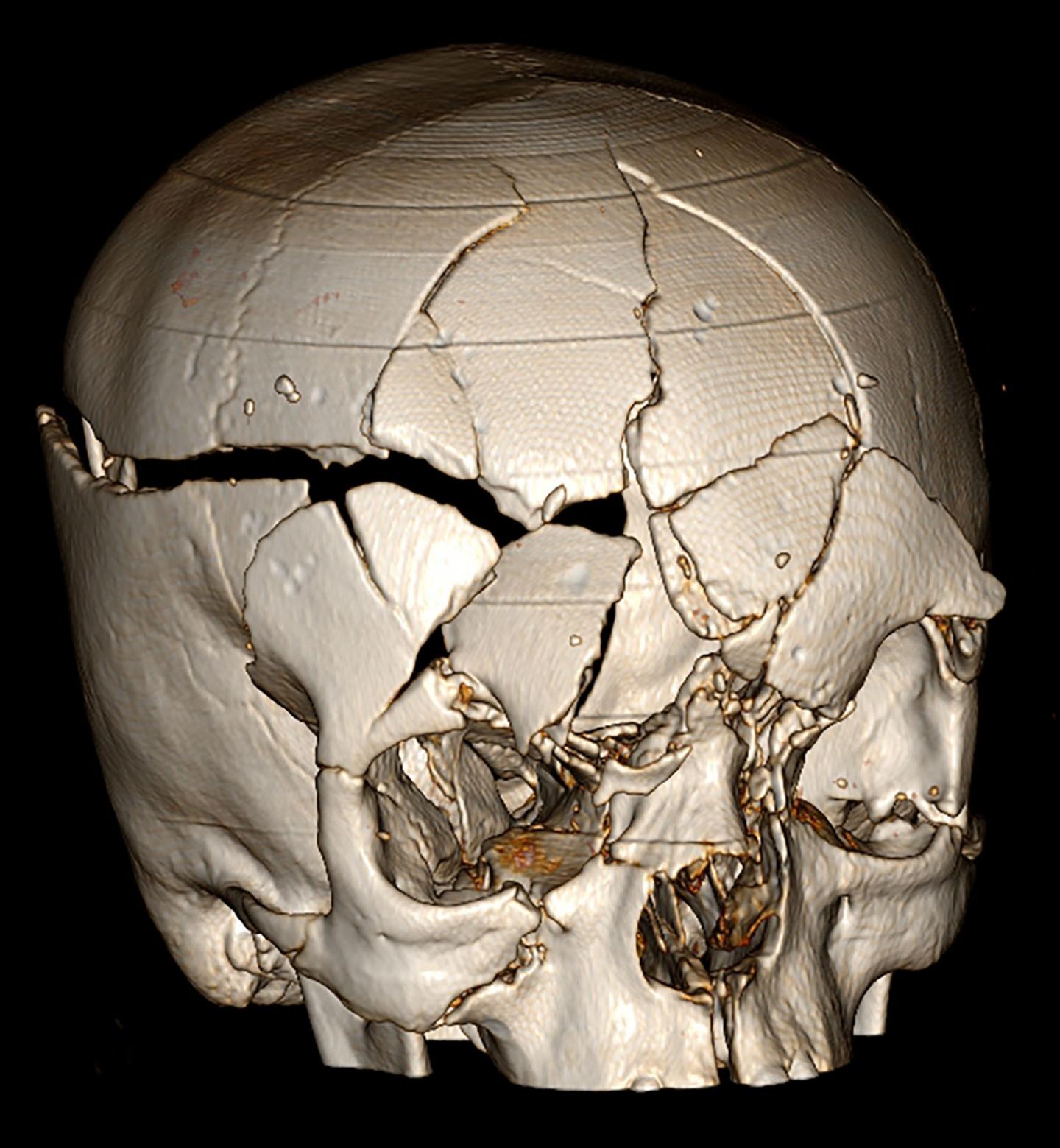 Traumatic Brain Injuries are Increasing