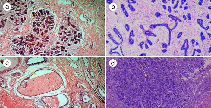 Diagnostic Performance of ATR-FTIR Spectroscopy in Discriminating Normal Breast Tissue and Breast Tumors