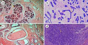 Diagnostic Performance of ATR-FTIR Spectroscopy in Discriminating Normal Breast Tissue and Breast Tumors