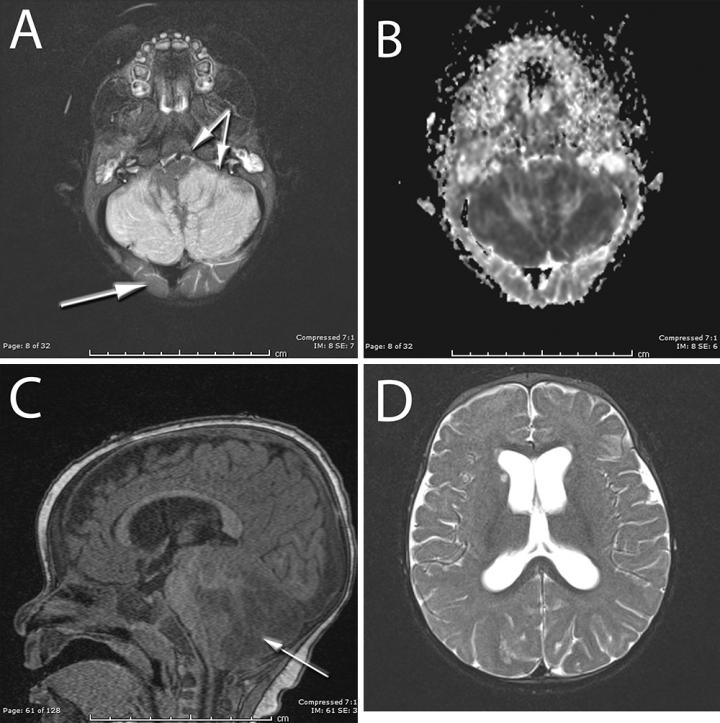 MRIs Obtained in Infant Following Ketamine Ingestion