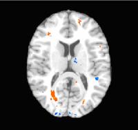 Mild Traumatic Brain Injury