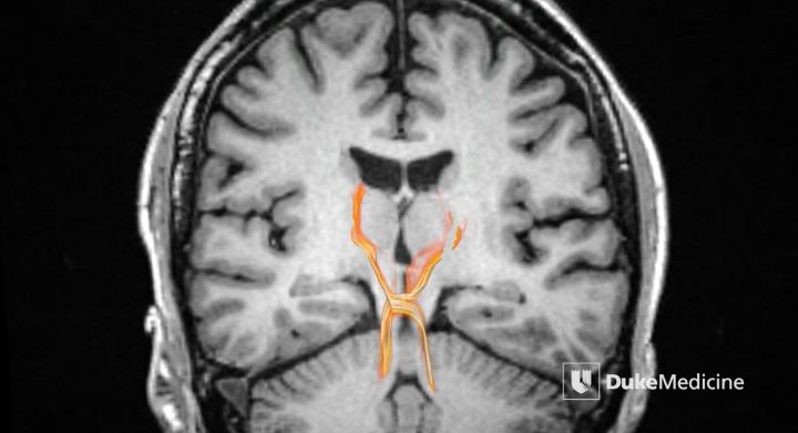 Image of Dentatorubrothalamic Tract