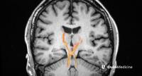 Image of Dentatorubrothalamic Tract