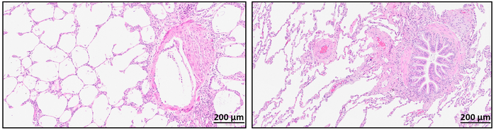 New study yields insights into chronic rejection after lung transplantation