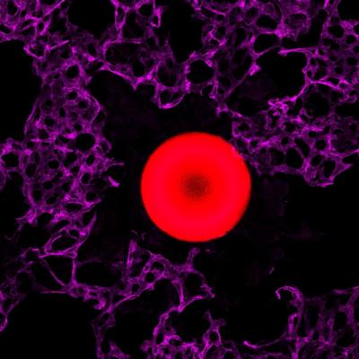 Two-Phased Clot Clearance Method May Hinder and Help (1 of 7)