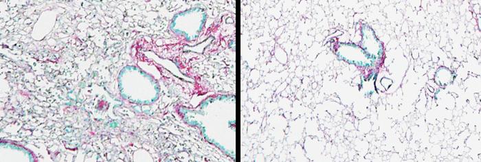 Advancing antifibrotic drug discovery