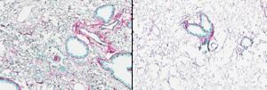 Advancing antifibrotic drug discovery