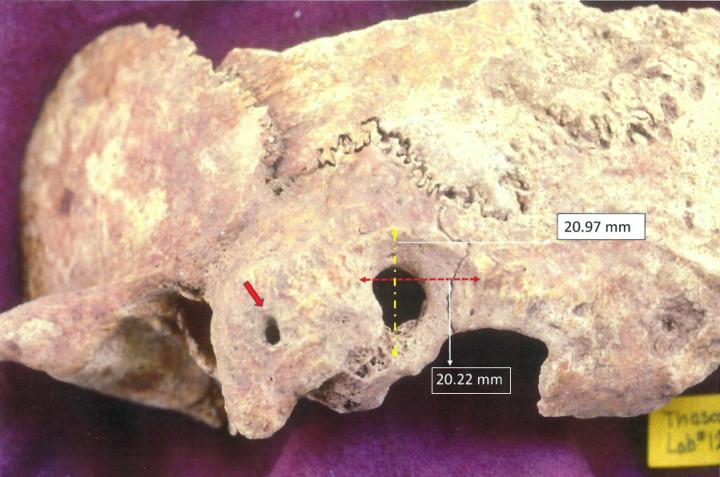 Ectocranial View of Palaeopathological Specimen