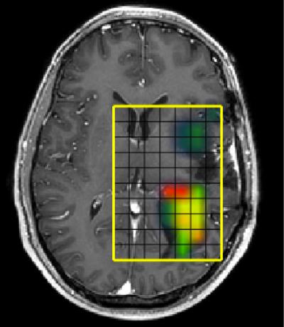 Why Tumors that Return Are So Tough (2 of 3)