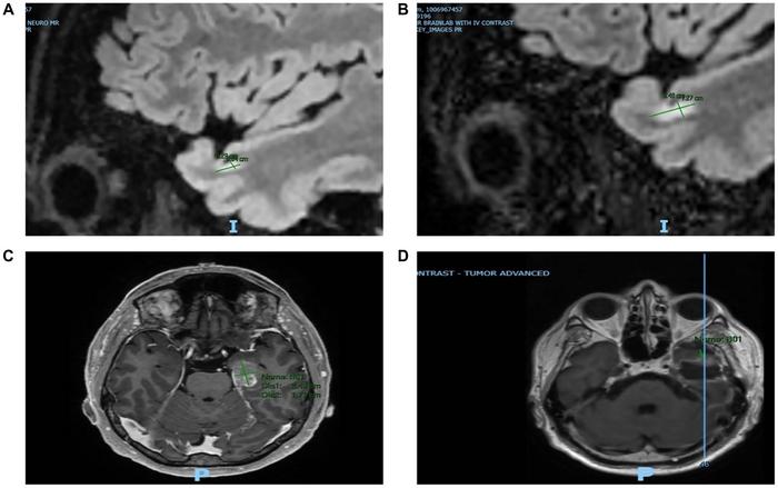 Case Report WIN-MTB-2024001 – WIN International Molecular Tumor Board: A 55-year-old male with glioblastoma exhibiting amplifications in MDM2 and EGFR
