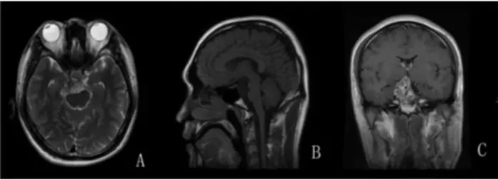 Understanding clinical outcomes, symptoms, diagnosis, and treatment of sellar chondrosarcomas