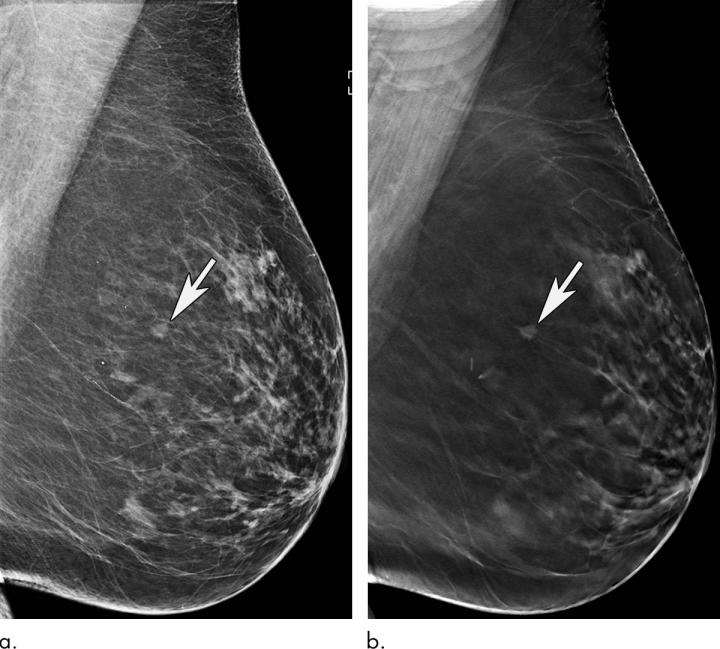 Older Women Benefit Significantly When Screened with 3-D Mammography