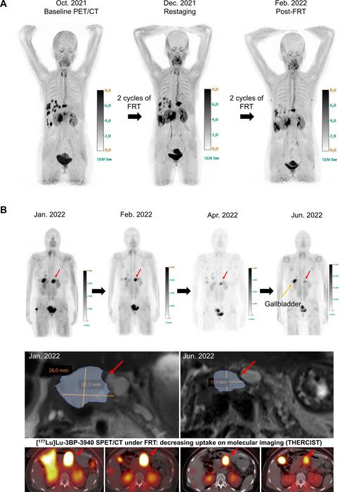 FAP-Targeted Radiopharmaceutical Therapy Shows Broad Effectiveness Across Multiple Cancers