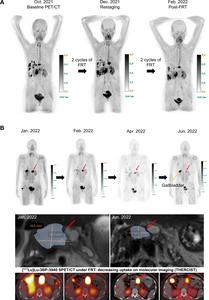 FAP-Targeted Radiopharmaceutical Therapy Shows Broad Effectiveness Across Multiple Cancers