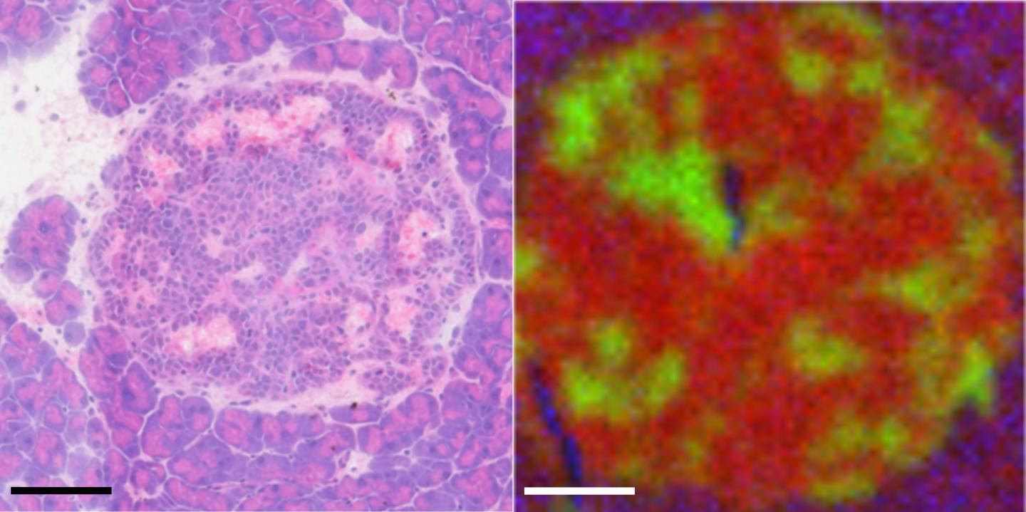 Islet Tumor Region