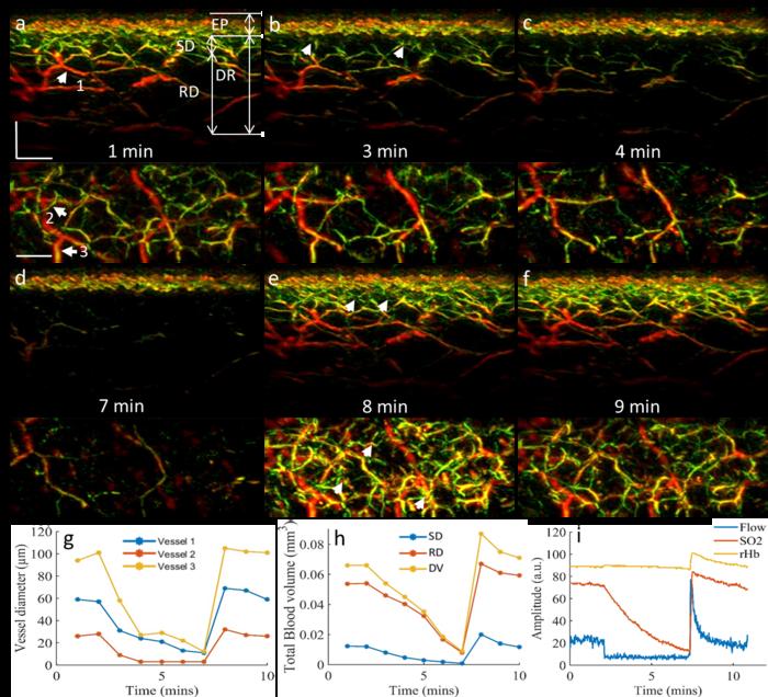 Figure 2 | 3D-RSOM imaging of skin microvasculature hyperemia during PORH.