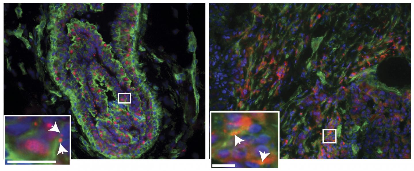 Comparison of Tumors and Healthy Breast Tissue