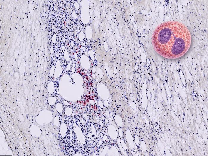 immunohistochemistry slide with specific staining for eosinophils