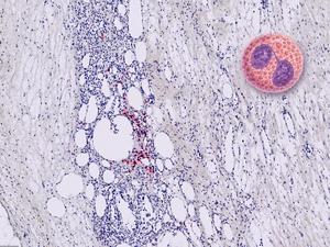 immunohistochemistry slide with specific staining for eosinophils