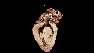 Rendering of a heart with Tetralogy of Fallot showing the septal defect