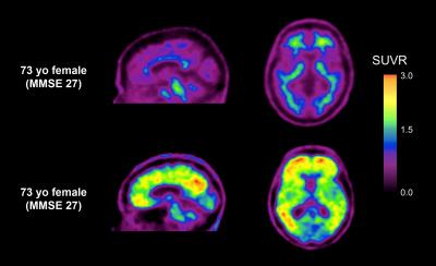 Tracing the Impact of Amyloid Beta in Mild Cognitive Impairment