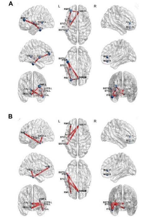 Brain Network Mapping After RF-TC Epilepsy Treatment