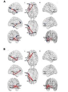 Brain Network Mapping After RF-TC Epilepsy Treatment