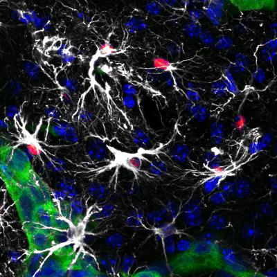 MetÃ¡stasis Cerebral