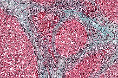 Cirrhotic Liver