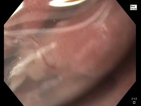 Hookworm in Gut