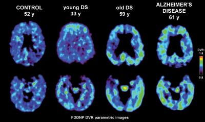PET-FDDNP Brain Scans