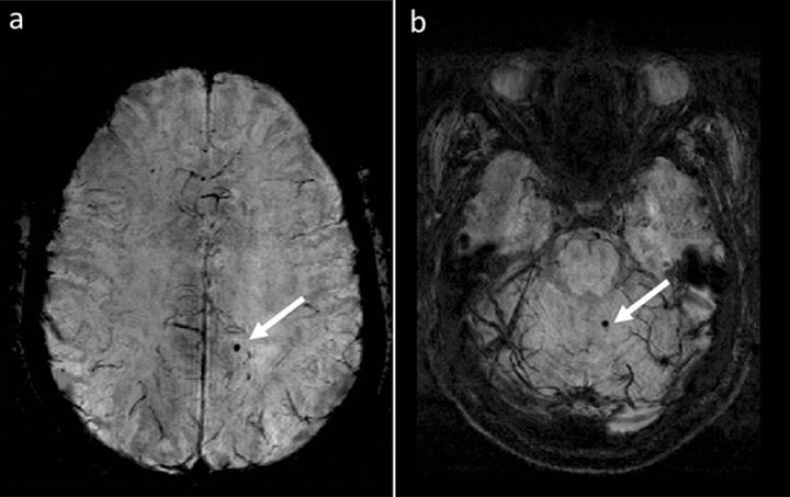 Cerebral Microbleeds in Multiple Sclerosis