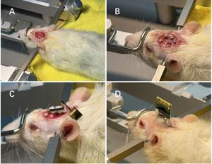 BCI implantation surgical process.